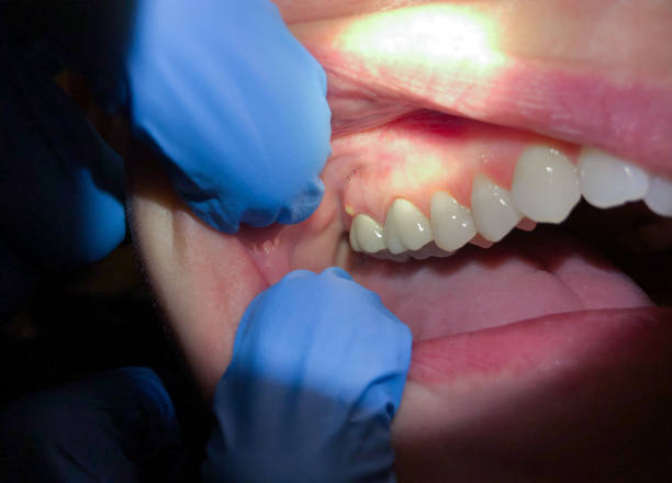 Best Knocked-Out Tooth Emergency  in Bear Creek, FL